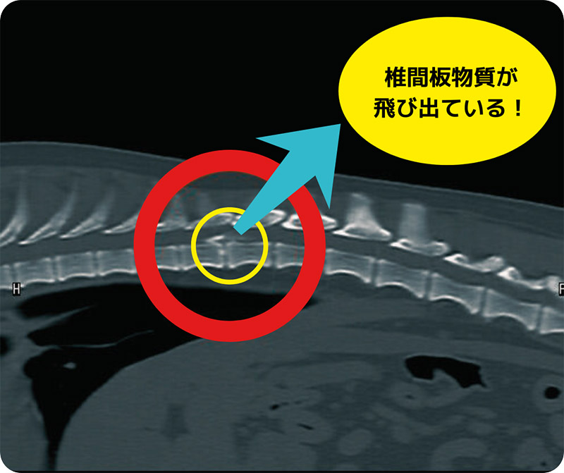 CT写真、椎間板物質が飛び出している例1