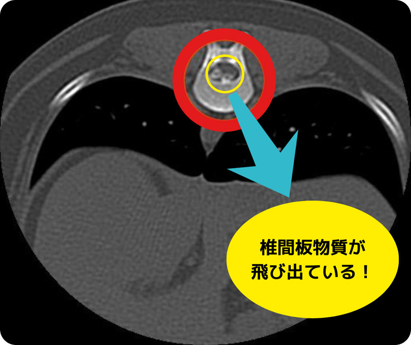 CT写真、椎間板物質が飛び出している例2